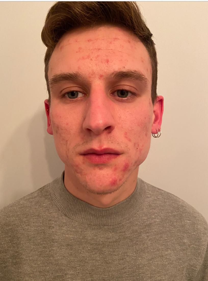 My Experience with KLARSKIN by Liam Reeves