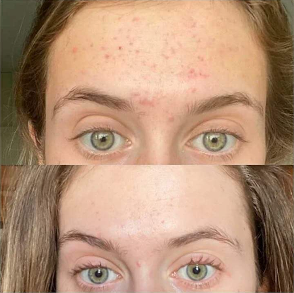 Review: How Klarskin Radiance Powder Helped Clear My Adult Acne