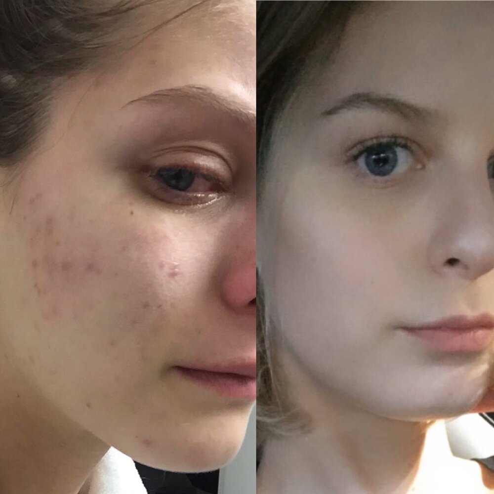 Getting to the root cause of acne