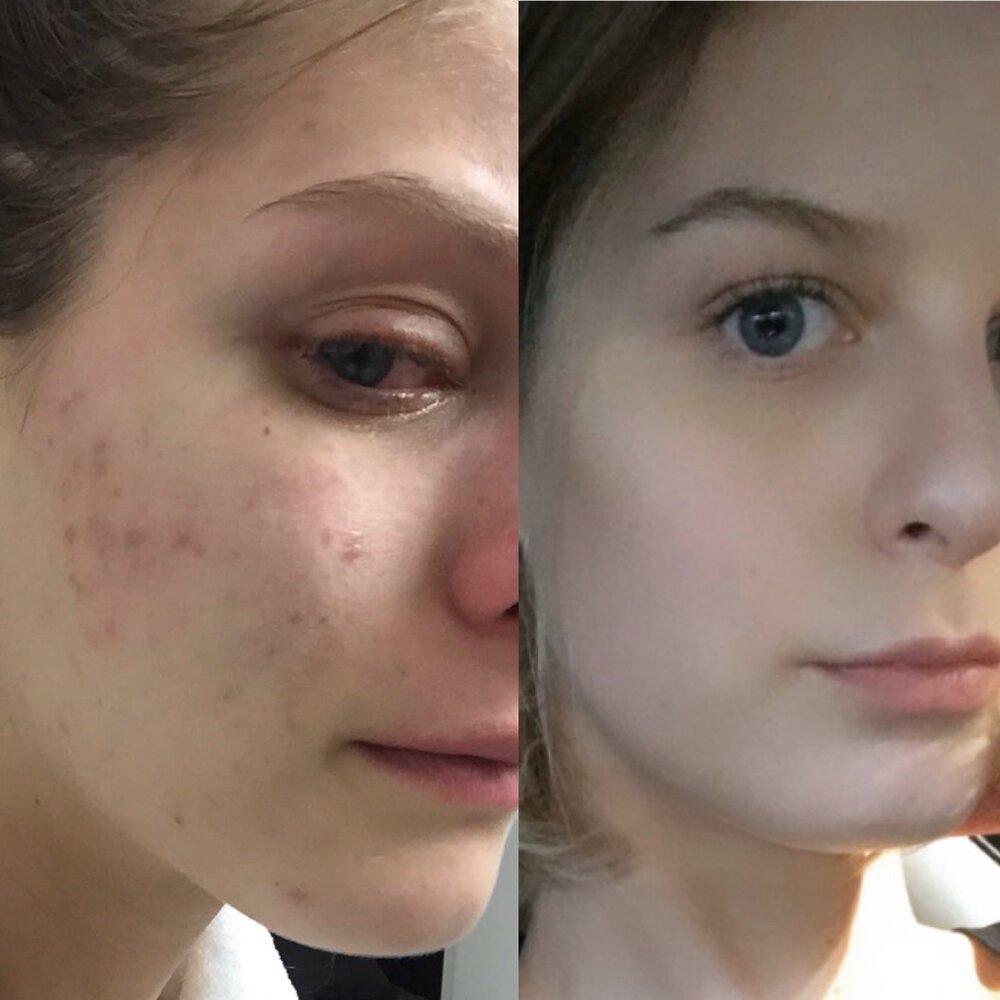 GETTING TO THE ROOT CAUSE OF ACNE