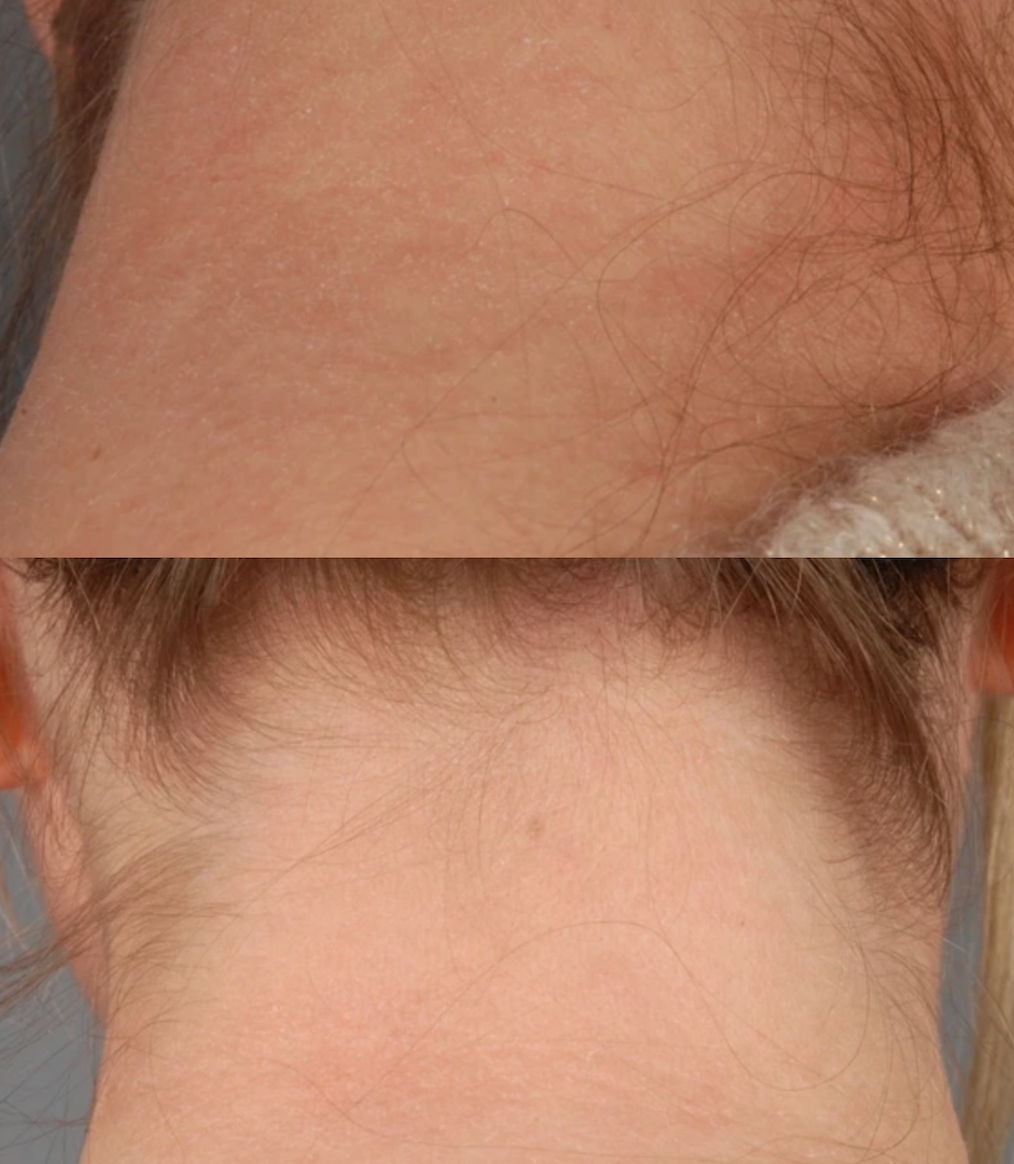 ATOPIC DERMATITIS TRIGGERS