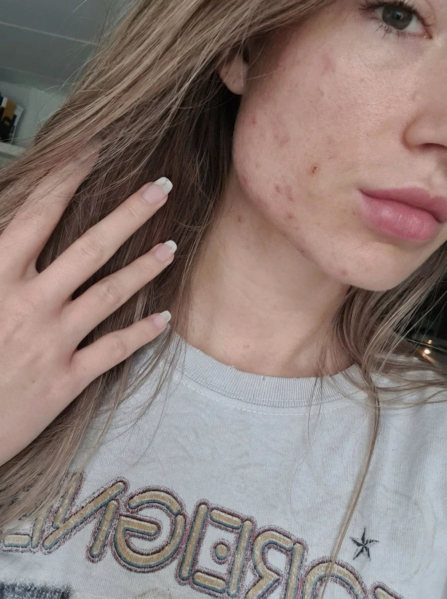 Laura before klarskin