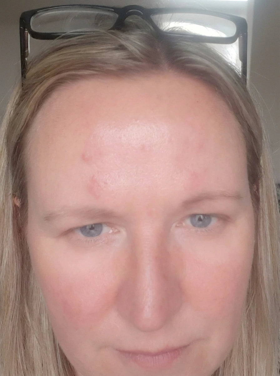 Sandra after klarskin